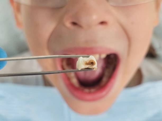 Best Emergency Treatment for Oral Infections in Fulton, TX